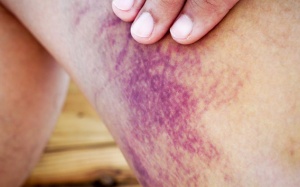 Bị bầm tím: Khi nào gây nguy hiểm?