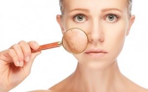 Những lý do khiến da mặt bị nám, sạm