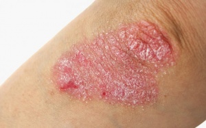 5 điều về bệnh vẩy nến bạn không nên bỏ qua!