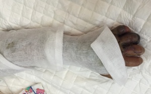 Bệnh nhi hoại tử bàn tay do gia đình tự ý đắp thuốc lá chữa rắn cắn