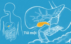 Viêm đường mật là gì và 4 dạng viêm đường mật thường gặp