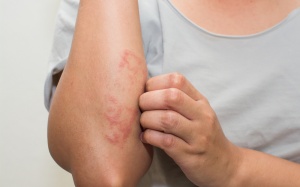 8 tác nhân không ngờ gây viêm da tiếp xúc