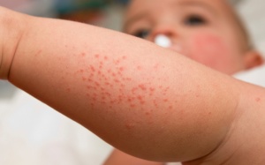 10 cách khắc phục bệnh eczema ở trẻ em