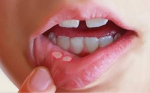 Nấm miệng có nên bôi kem thảo dược Subạc?