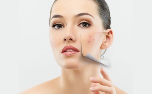 Có nên sử dụng thuốc nội tiết tố nữ điều trị mụn?