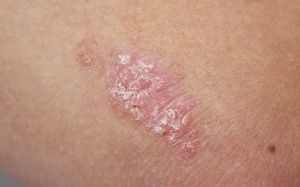 Các phản ứng viêm ảnh hưởng đến cơ thể như thế nào?