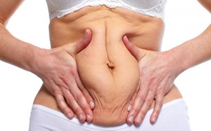 Làm gì khi bị da nhăn nheo sau sinh?