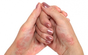 Mắc vảy nến 10 năm rồi có nên dùng Kim Miễn Khang và Explaq?