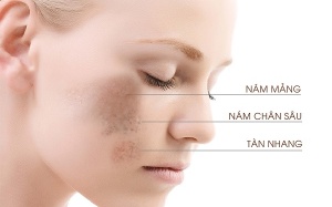 Những thảo dược giúp cải thiện tình trạng nám da hiệu quả