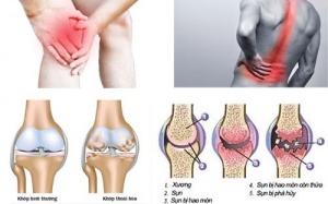 Cơ hội khám bệnh miễn phí cho người bệnh cơ xương khớp