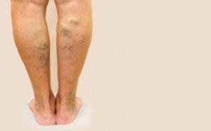 Những yếu tố làm tăng nguy cơ giãn tĩnh mạch mà bạn nên biết