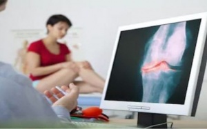 3 biện pháp tự nhiên giúp giảm viêm xương khớp