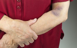 Làm thế nào để giảm vết thâm tím trên tay?