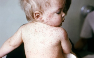Trẻ bị sốt và nổi mẩn đỏ có phải bị bệnh sởi? 