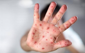 Cách điều trị bệnh tay chân miệng và phòng ngừa bệnh cho trẻ