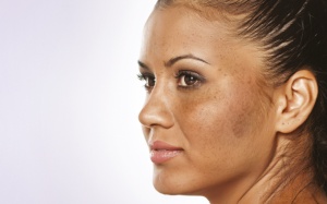 7 cách giúp phòng tránh nám da sau khi sinh