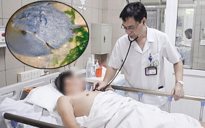 Liệt toàn thân và suy hô hấp nặng do ăn so biển