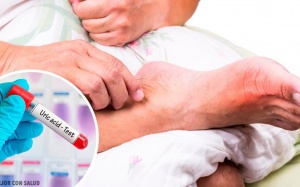 5 nguyên nhân khiến nồng độ acid uric trong máu cao