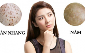 Nám và tàn nhang khác nhau thế nào?