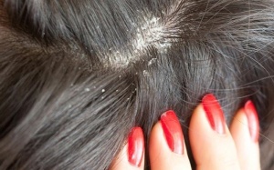  9 cách đơn giản giúp hạn chế gàu trong mùa Đông