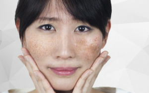 Nám da mặt vùng má: Dấu hiệu tuổi già “sầm sập” kéo đến