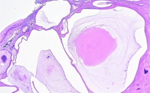Nang naboth cổ tử cung có chuyển thành ung thư? 