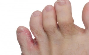 Gia đình có người bị nấm chân, làm sao để tránh bị lây bệnh?