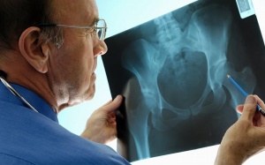 Người bệnh loãng xương nên kiêng ăn gì?