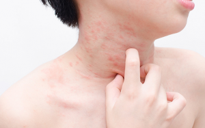 Phát ban nhiệt ở trẻ em có nguy hiểm?