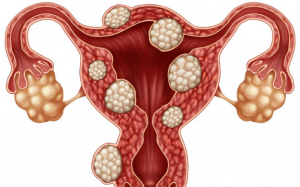 Bị u xơ tử cung nên ăn uống thế nào để bệnh giảm, không tăng nặng?