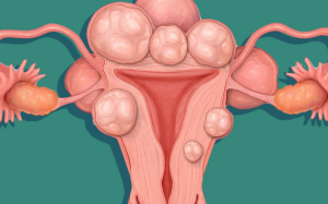 Cách tự nhiên giúp điều trị u xơ tử cung 