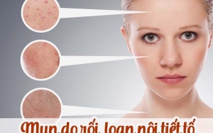 Những điều cần biết về mụn nội tiết