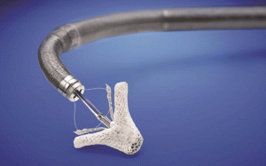 Thiết bị đặc biệt MitraClip có thể giúp điều trị suy tim