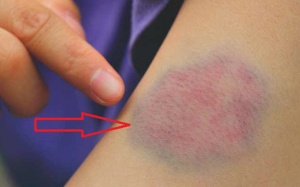 9 biện pháp tự nhiên giúp loại bỏ các vết bầm tím xấu xí