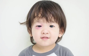 Đau mắt ở trẻ sơ sinh và trẻ nhỏ: Do đâu và điều trị thế nào?