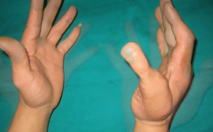 Phẫu thuật chuyển ngón chân thành ngón tay cái