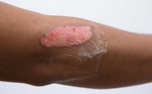 4 cách tự nhiên chữa bỏng nhẹ tại nhà