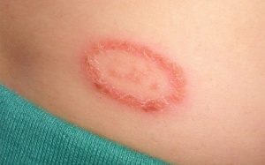 5 biện pháp tự nhiên giúp hỗ trợ điều trị hắc lào