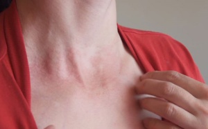 Ăn uống, vệ sinh thế nào để vẩy nến không nặng thêm?