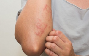 Hồng ban nút hay tái phát cải thiện bằng cách nào?