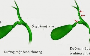 Teo mật bẩm sinh: Bệnh lý dễ bị nhầm với bệnh vàng da sinh lý, viêm gan