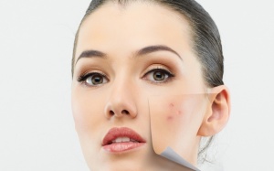 Những nguyên nhân khiến người trưởng thành bị mụn