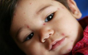 Trẻ bị phát ban khắp người: Bệnh gì? Chữa thế nào? 