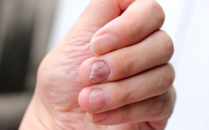 6 biện pháp tự nhiên giúp giảm vẩy nến móng