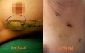 Không lo bị sẹo khi mổ u xơ tuyến vú qua đường nách