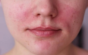 7 thực phẩm có thể kích hoạt bệnh đỏ mặt rosacea