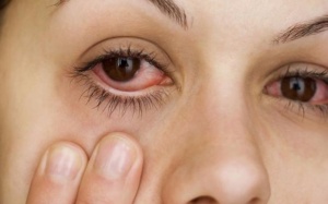 5 nguyên nhân khiến mắt bạn bị đỏ