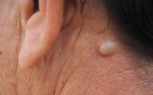Nổi u ở cổ và tai do đâu?