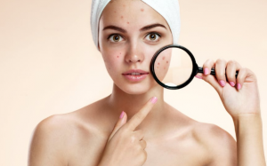 Trị mụn cho bà bầu: Tưởng khó mà lại dễ