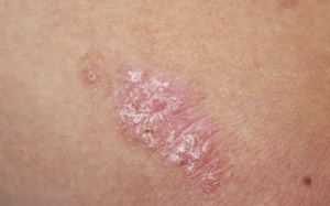 4 biện pháp giúp bạn điều trị vẩy nến tại nhà an toàn, hiệu quả